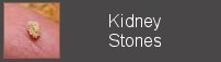 kidney stones