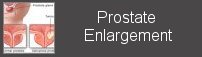 prostate enlargement