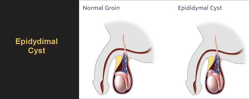 Epidydimal cysts