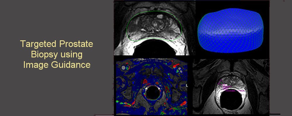 prostate biopsy