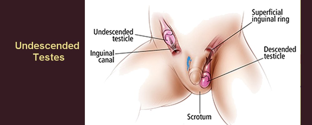 Undescended Testicles