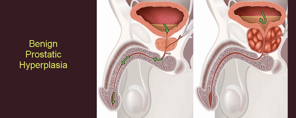 Benign prostatic hyperplasia